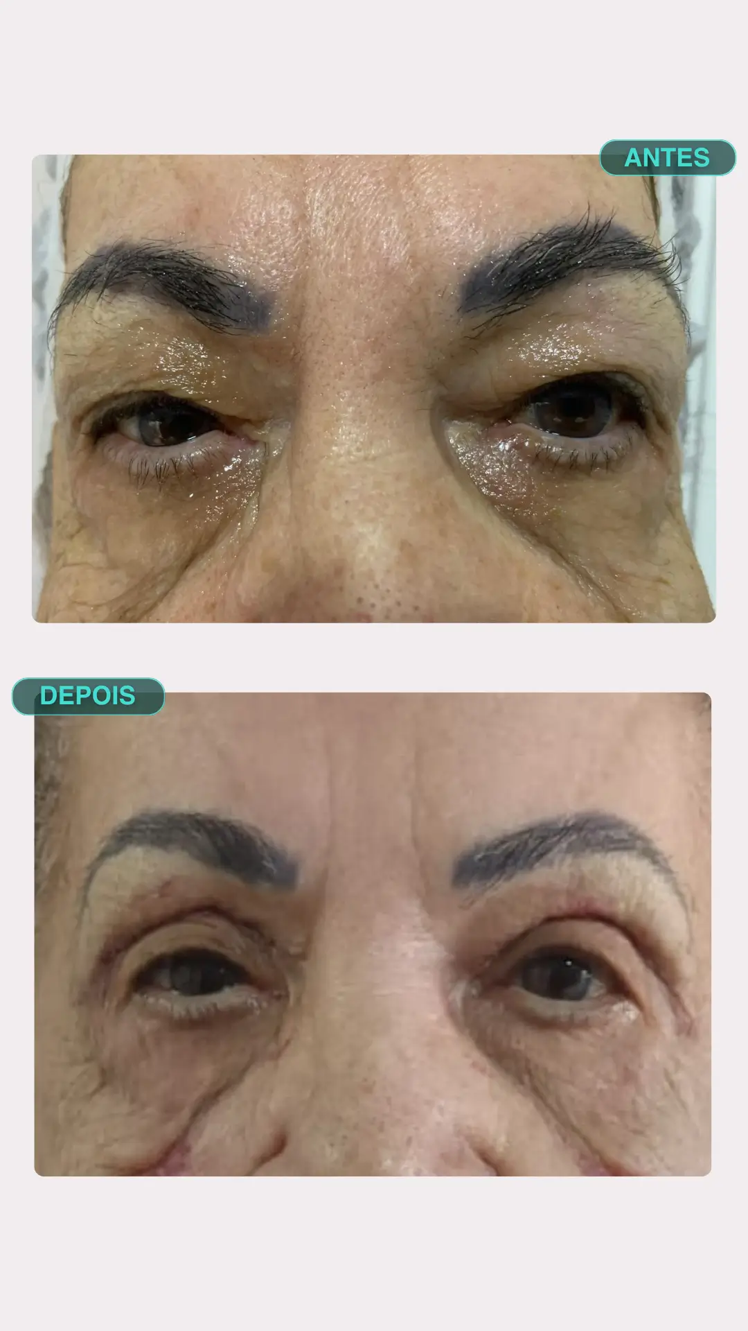 Blefaroplastia a Laser — antes e depois, paciente 2