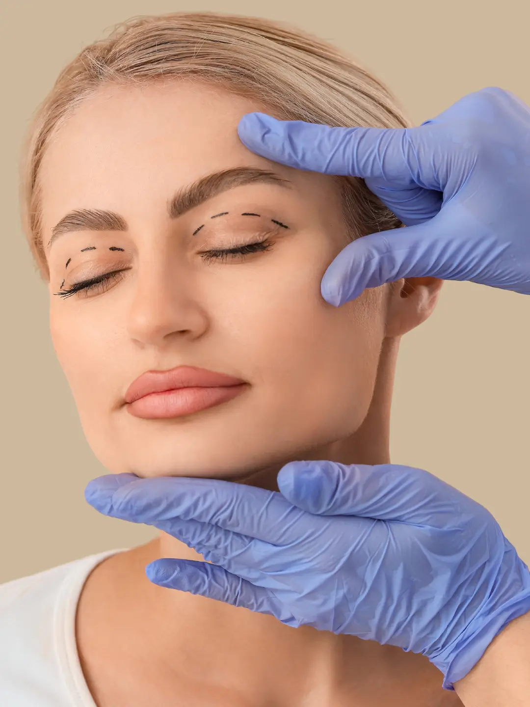 Blefaroplastia a Laser — antes e depois